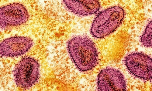 First Case of New Mpox Variant Clade 1b Detected in Germany